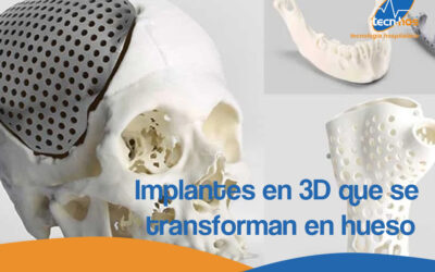 Implantes en 3D que se transforman en hueso