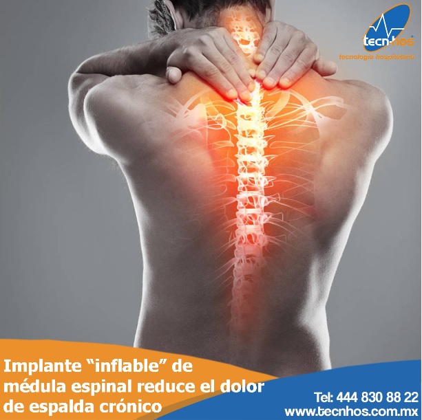 Implante “inflable” de médula espinal podría reducir el dolor de espalda crónico